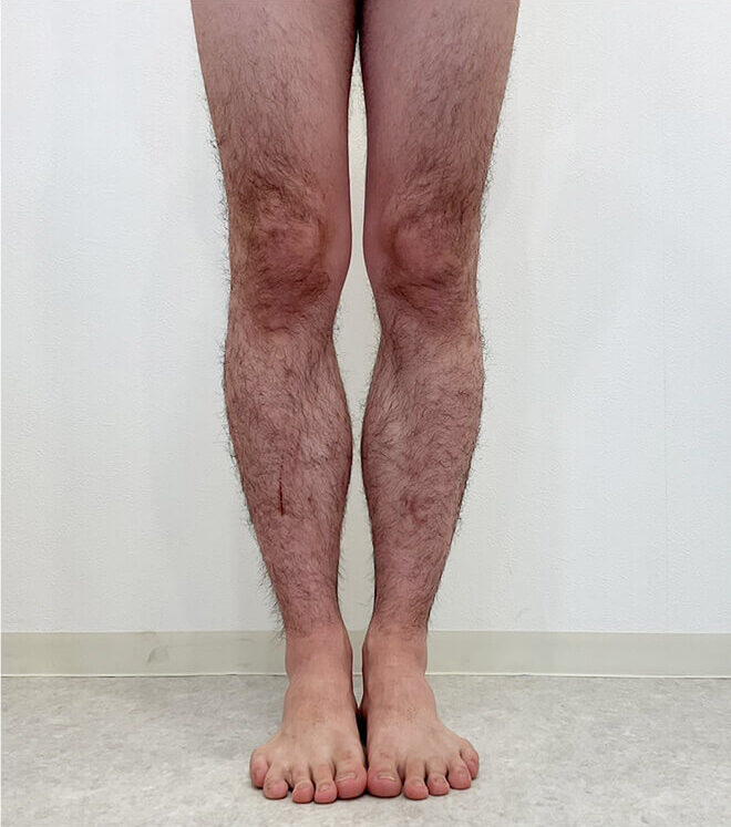 20代足施術前