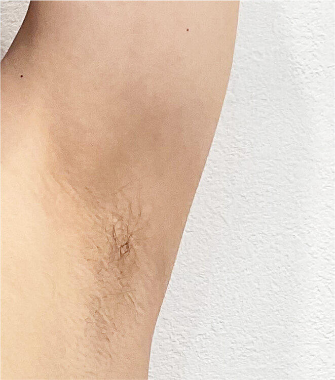 20代脇5回目施術前