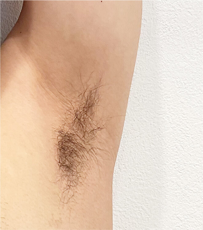 20代脇施術前